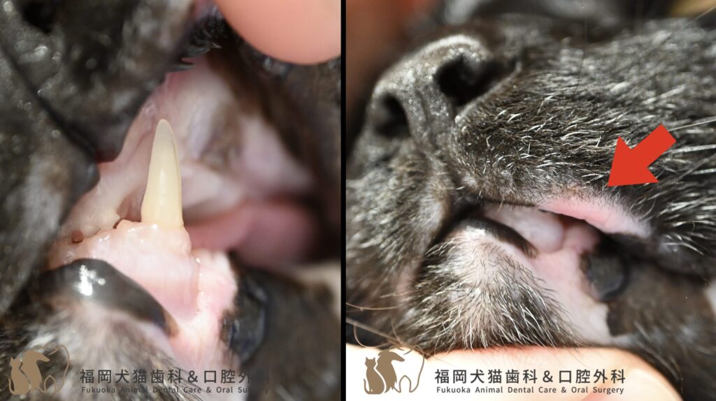猫の上顎犬歯抜歯後に上顎口唇に炎症が見られる写真。下顎犬歯が口唇に触れている写真