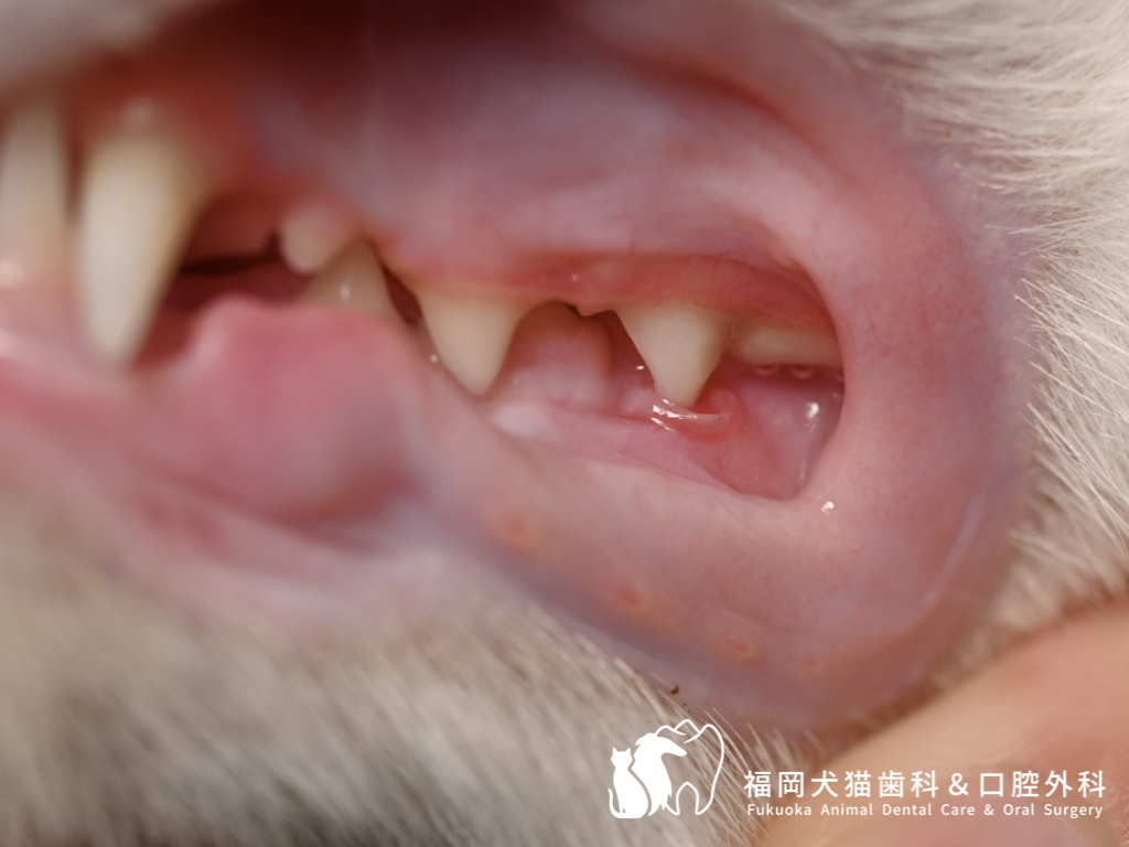 上顎臼歯の先端が下顎臼歯の頬側歯肉粘膜に触れている。歯肉の潰瘍が見られる症例。口腔内写真
